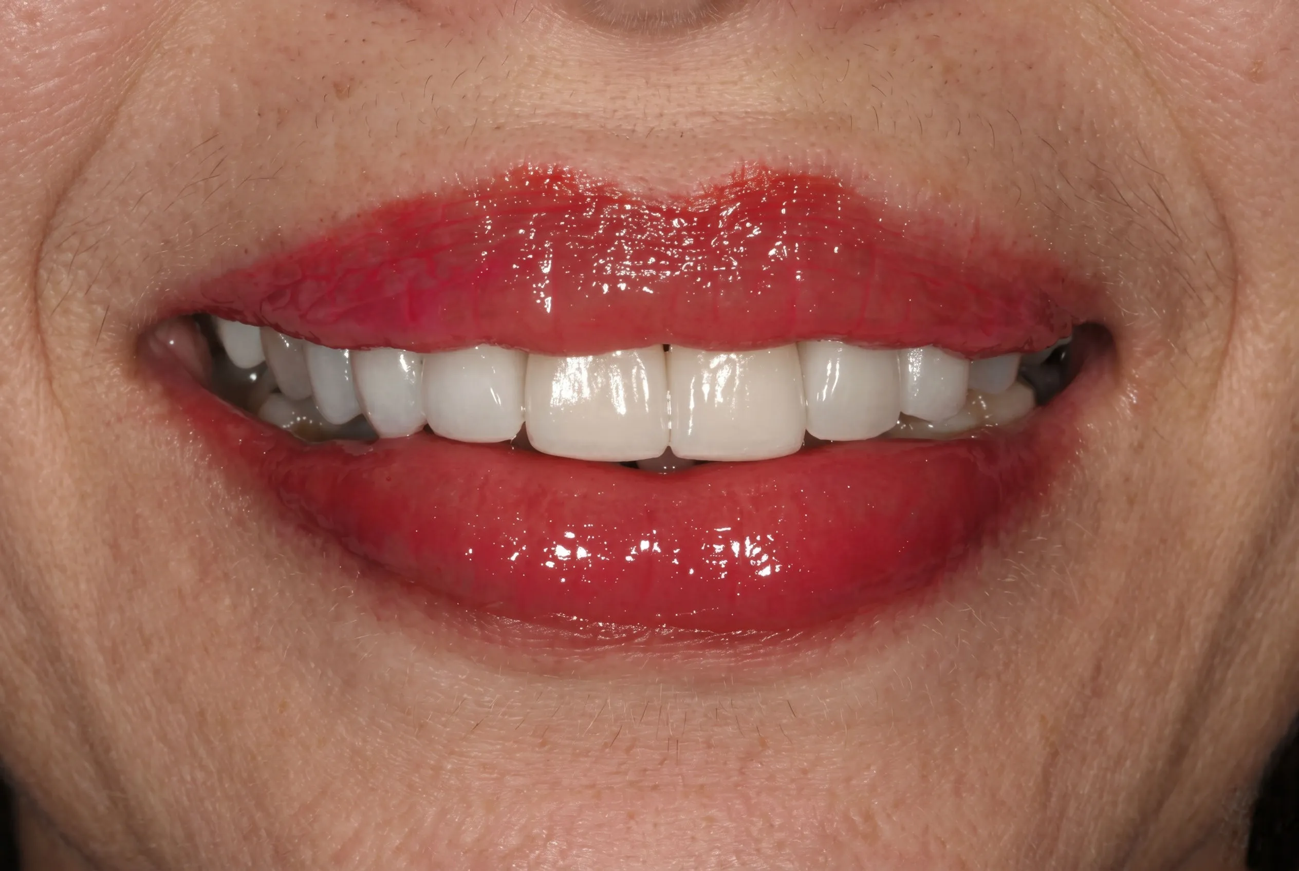 Full Mouth Rehabilitation - After
